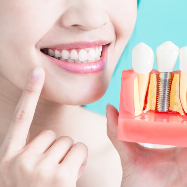 Dental Implants